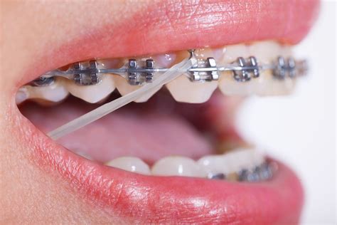 underbite metal bracket rubber bands|rubber bands for anterior bite.